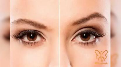 تفاوت لیفت شقیقه و دایرکت ابرو | کدام روش برای افتادگی ابرو بهتر است؟
