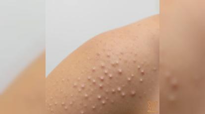 همه چیز درباره جوش های پشت بازو یا پوست مرغی: از علت تا درمان در مشهد