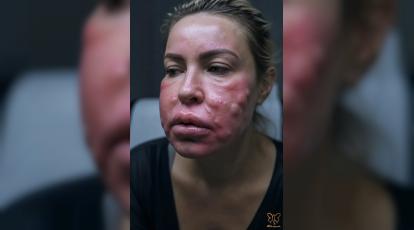 تفاوت فیلر اصل و تقلبی: انتخاب کلینیک معتبر تزریق ژل در مشهد