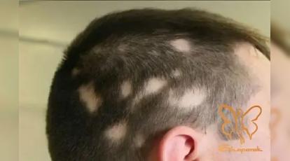 کمبود این ویتامین پنهان، دلیل اصلی ریزش موی سکه‌ای شماست