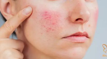 ممنوعیت های خدمات زیبایی برای پوست حساس و اگزمایی! کلینک شاپرک مشهد 