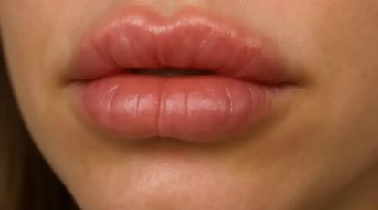 از تزریق ژل لب خود ناراضی هستید؟ راهنمای کامل اصلاح فرم و تخلیه ژل در مشهد