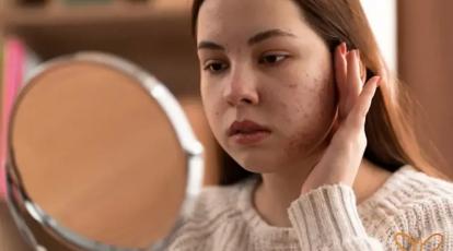 جای جوش و اسکار آکنه؟ پایانی بر نبرد هر روزه با آینه در کلینیک شاپرک طلایی 