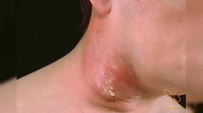 بیماری کفگیرک چیست؟ درمان قطعی و فوری در مشهد + عکس