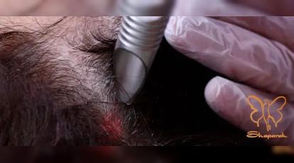 توقف ریزش و رویش مجدد مو با فوتونا میکرودرلینگ سر در کلینیک شاپرک مشهد