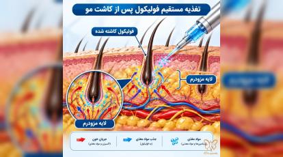 بهترین زمان شروع مزوتراپی و PRP بعد از کاشت مو (جدول زمانی طلایی)