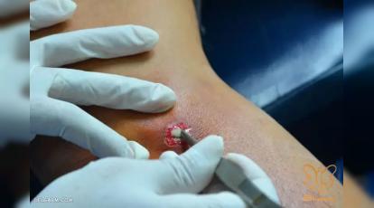 بیماری کفگیرک چیست؟ درمان قطعی و فوری در مشهد + عکس