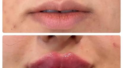 تزریق ژل لب در مشهد تجربه لب‌هایی پرحجم و جذاب با بهترین قیمت 