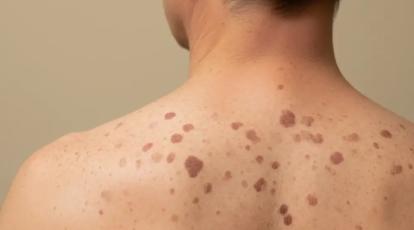 آیا بیماری ماکولار درمان قطعی دارد؟ پاسخ صادقانه و بهترین روش کنترل آن در مشهد