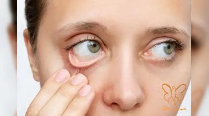 چگونه با جبران کمبود آهن، موهایی پرپشت و پوستی درخشان داشته باشیم؟