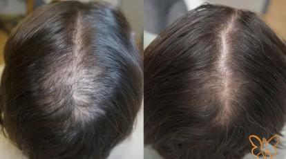 هیرفیلر آلپاژینا + پی آر پی PRP: جدیدترین متد رشد مجدد مو در مشهد