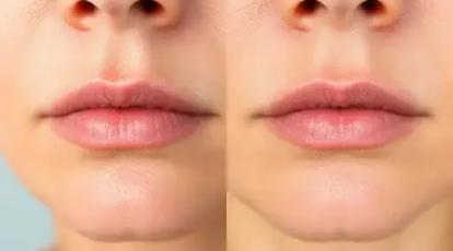چگونه بوتاکس چانه، بافت پوست پرتقالی را ظرف ۷ روز به چانه‌ای صاف و مخملی تبدیل می‌کند؟