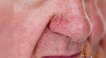 درمان قطعی رگ‌های عنکبوتی بینی در مشهد | خداحافظی با قرمزی پوست در یک جلسه