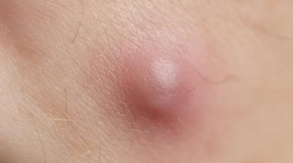 نجات پوست از جوش زیر پوستی در مشهد: فرمول درمانی پیشرفته کلینیک شاپرک که پوست شما را احیا می‌کند