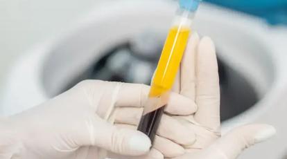 تعداد جلسات PRP مو چقدر است؟  راهنمای کامل کلینیک شاپرک طلایی مشهد