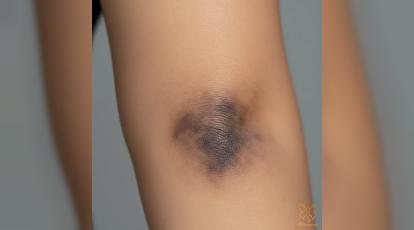 علت تیرگی آرنج چیست؟ بهترین روش‌های روشن کردن آن در مشهد کدامند؟