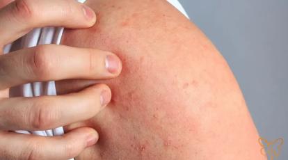راش پوستی (Rash) چیست؟ انجام خدمات ایمن زیبایی در کلینیک شاپرک مشهد