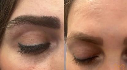 مراقبت‌های حیاتی بعد از کاشت ابرو در کلینیک شاپرک طلایی