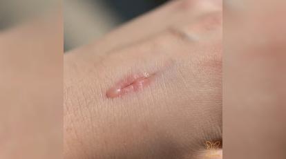 خونابه بعد از بخیه جراحی: طبیعی است یا خطرناک؟ | راهنمای کامل کلینیک شاپرک طلایی مشهد