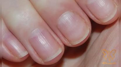 کلینیک شاپرک مشهد: از تشخیص تا درمان ناخن‌ های کبریتی