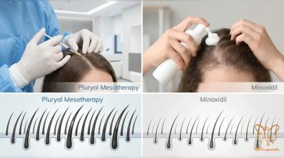 مزو پلوریال سر یا ماینوکسیدیل؟ مقایسه کامل بهترین درمان‌های ریزش مو در مشهد