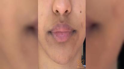 تیرگی دور لب و تنبلی تخمدان؛ خداحافظی با لک‌های هورمونی در کلینیک شاپرک