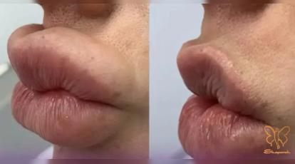 چرا لب‌های روسی بعد از مدتی “اردکی” می‌شوند؟ پیشگیری از جمع شدن ژل در پشت لب 