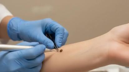 لیزر یا فریز کردن خال؟ | راهنمای کامل انتخاب بهترین روش در مشهد + هزینه