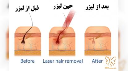 لیزر مو‌های زائد در مشهد برای چه کسانی ضرر دارد؟