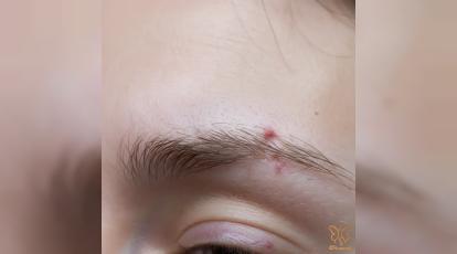 آیا ریزش ابروهایتان هشدار تیروئید کم‌کار است؟ روش های درمان در مشهد