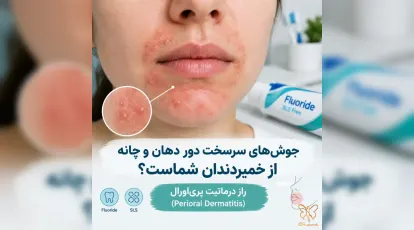 جوش‌های سرسخت دور دهان و چانه از خمیر دندان شماست؟ راز درماتیت پری‌اورال (Perioral Dermatitis)