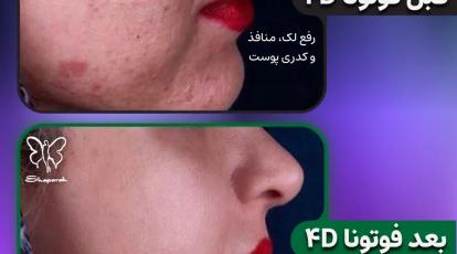 مراقبت بعد از لیزر فوتونا 4D: راهنمای کامل کلینیک شاپرک طلایی برای دو برابر کردن نتایج