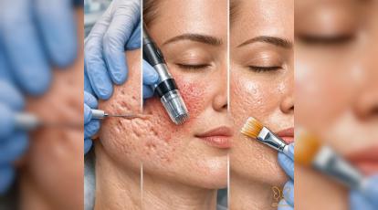 ساندویچ تراپی چیست؟ از بین بردن اسکار آکنه عمیق با متد ۳ بعدی در مشهد
