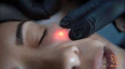 اندولیفت برای اسکار: راه حلی نوین برای درمان اسکار و آکنه در کلینیک شاپرک طلایی