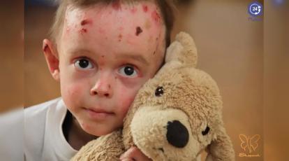 بیماری پروانه ای چیست؟ حقایقی درباره کودکان پروانه‌ای در مشهد