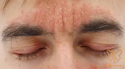 پوسته پوسته شدن صورت نشانه چیست؟ درمان قطعی در بهترین کلینیک پوست مشهد