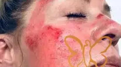 احساس سوختگی بعد از پیلینگ؛ آیا طبیعی است یا خطرناک؟ (راهنمای کامل)