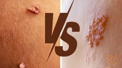 تبخال و زگیل تناسلی (HPV و HSV): آیا انجام خدمات زیبایی مجاز است؟