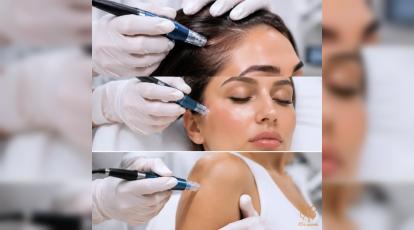 راهنمای جامع نیدلینگ نواحی مختلف: بهترین روش رفع جای جوش، ترک بدن و رشد مجدد مو در مشهد