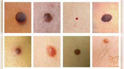 انواع خال های پوستی و شناخت آن ها در مشهد