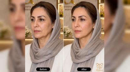 چرا هایفو برای شکم بی‌تاثیر است؟ بهترین روش لیفت صورت در کلینیک شاپرک مشهد