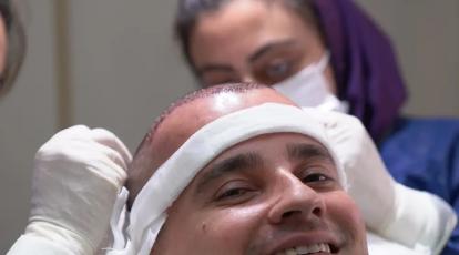 ورم بعد از کاشت مو چقدر طول می‌کشد؟ | راهنمای کامل کلینیک شاپرک طلایی