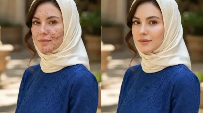 سابسیژن تخصصی برای احیای بافت پوست و رفع فرورفتگی‌ها در مشهد