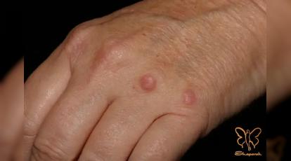 گرانولوما چیست؟ راه های درمان قطعی آن در مشهد