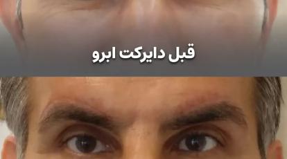 درمان قطعی افتادگی و پف چشم: مقایسه کامل بلفاروپلاستی و دایرکت ابرو در کلینک شاپرک طلایی مشهد