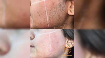 موهای زخیم یا نازک؟ تاثیر نوع مو بر موفقیت لیزر موهای زائد در مشهد