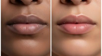 درمان تخصصی سیاهی دور لب: اثربخشی 100% با بهترین روش های درمانی در شاپرک طلایی مشهد