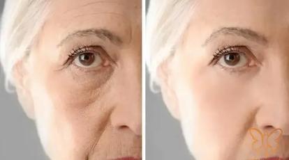 اگر از عمل های زیبایی تهاجمی می‌ترسید، نانوفت بهترین انتخاب شماست!