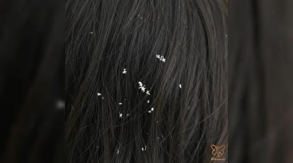 آیا واقعا شوره سر ناشی از خشکی پوست سر است؟