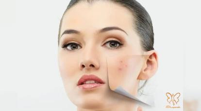 درمان ترکیبی لک‌های مقاوم صورت در مشهد | وقتی یک روش کافی نیست